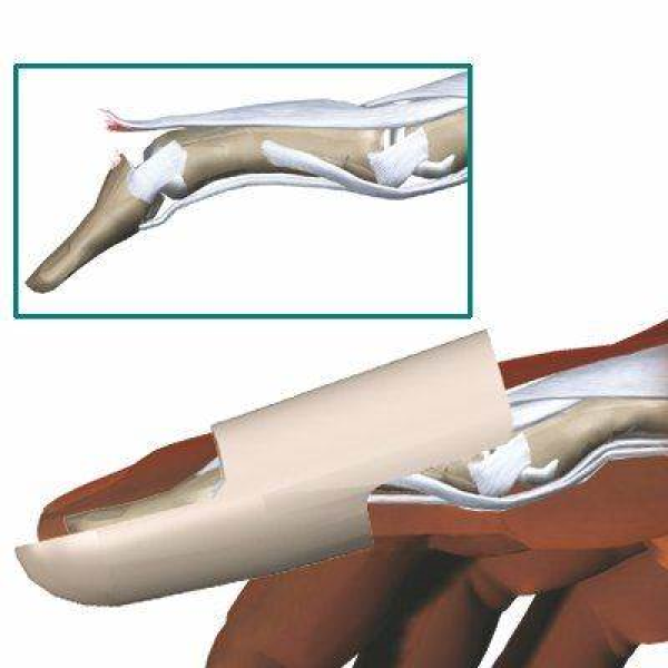 Ναρθηκας δαχτυλου πλαστικος Mallet Finger